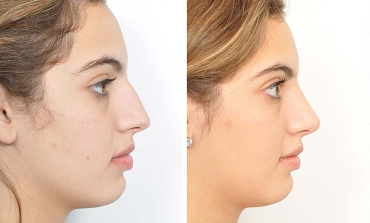 عکس بینی ترند